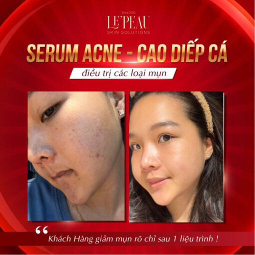 Serum mụn diếp cá LE'PEAU, hỗ trợ cải thiện mụn