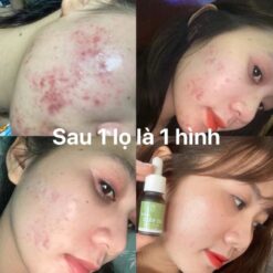 Serum Diếp Cá IGREEN Giải Pháp Hoàn Hảo Cho Da Mụn Thâm