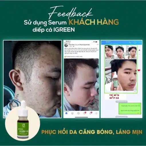 Serum Diếp Cá IGREEN Giải Pháp Hoàn Hảo Cho Da Mụn Thâm