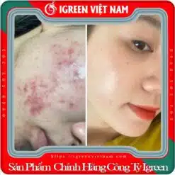 Serum Diếp Cá IGREEN, Giải Pháp Tự Nhiên Cho Da Mụn và Da Nhờn