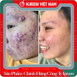 Serum Diếp Cá IGREEN, Giải Pháp Tự Nhiên Cho Da Mụn và Da Nhờn