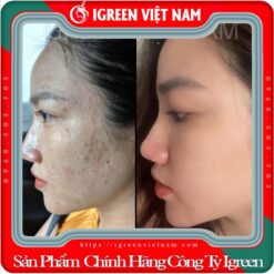 Serum Diếp Cá IGREEN, Giải Pháp Tự Nhiên Cho Da Mụn và Da Nhờn