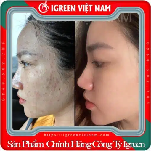 Serum Diếp Cá IGREEN, Giải Pháp Tự Nhiên Cho Da Mụn và Da Nhờn