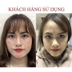 Serum Giảm Mụn Seimy Skin 7 Days 10ml 14 Serum Giảm Mụn Seimy