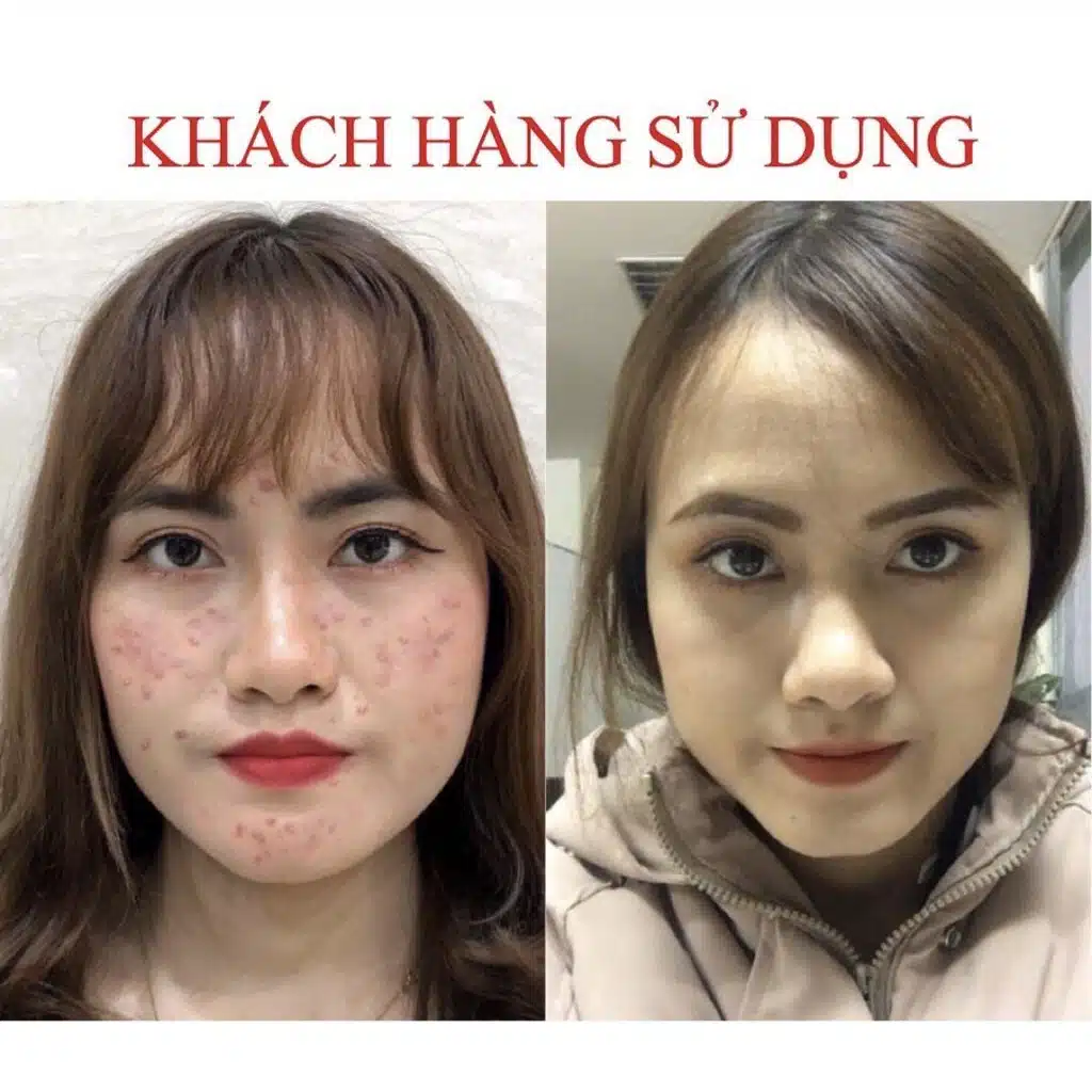 Serum Giảm Mụn Seimy Skin 7 Days 10ml 7 Serum Giảm Mụn Seimy