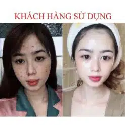 Serum Giảm Mụn Seimy Skin 7 Days 10ml 13 Serum Giảm Mụn Seimy