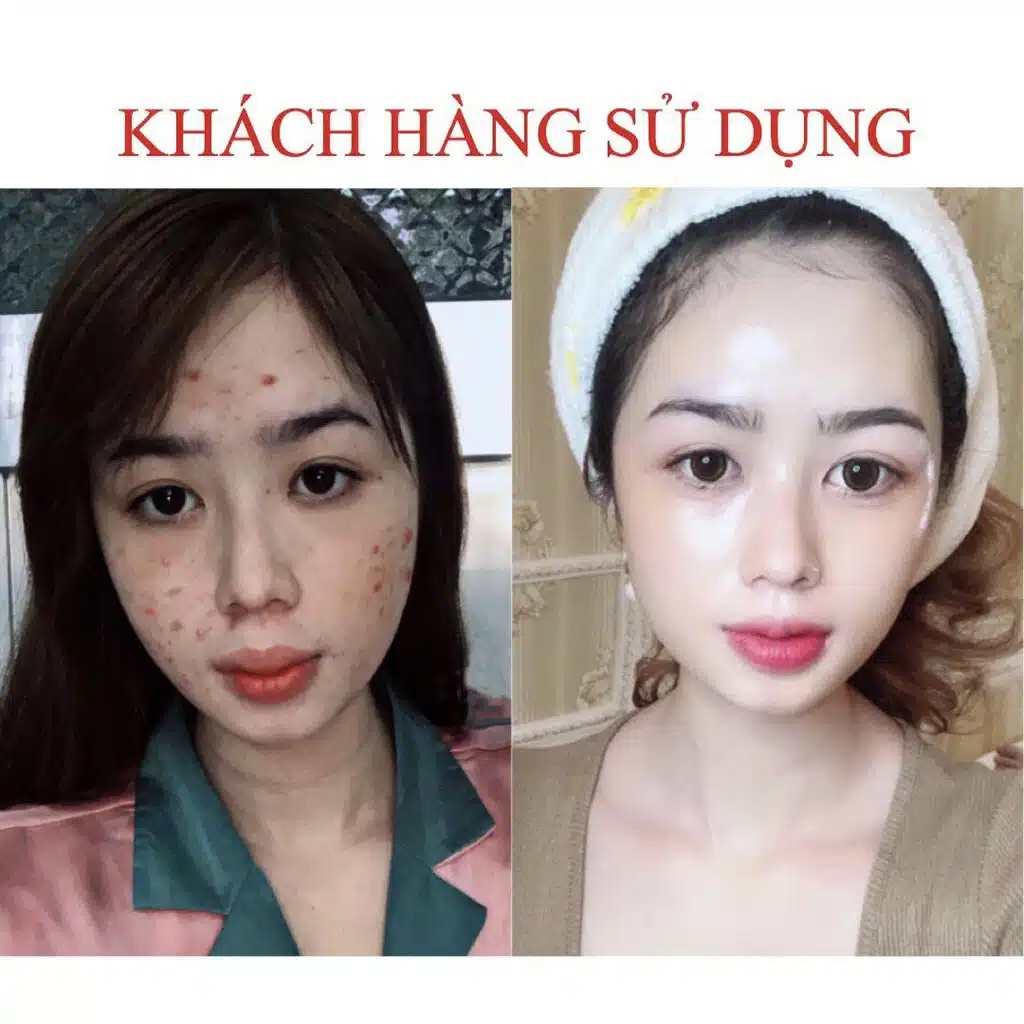 Serum Giảm Mụn Seimy Skin 7 Days 10ml 6 Serum Giảm Mụn Seimy