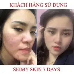 Serum Giảm Mụn Seimy Skin 7 Days 10ml 15 Serum Giảm Mụn Seimy