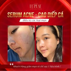 Serum Mụn Diếp Cá LE'PEAU - Giải Pháp Hiệu Quả cho Da Mụn 17 Serum mụn diếp cá LE'PEAU, hỗ trợ cải thiện mụn