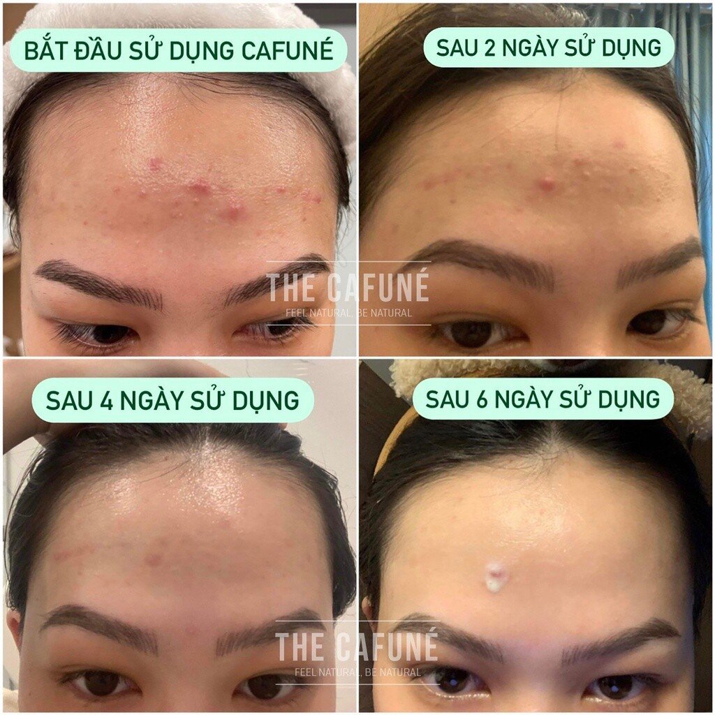 Tinh Chất Chấm Mụn Mờ Thâm Cafuné Essence - Thành Phần Serum AHA Tràm Trà Đánh Bay 7 Loại Mụn Thâm 8 Tinh Chất Chấm Mụn Mờ Thâm, Cafuné Essence, Thành Phần Serum AHA, Tràm Trà, Đánh Bay 7 Loại Mụn Thâm,