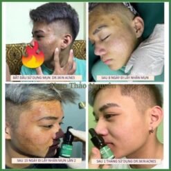 Serum mụn Dr.Skin acnes 5ml đánh bay mụn hết thâm làm mịn da hiệu quả trong 7 ngày 10 images upload woo2F904e860f8d69ec640d272b321feddae5