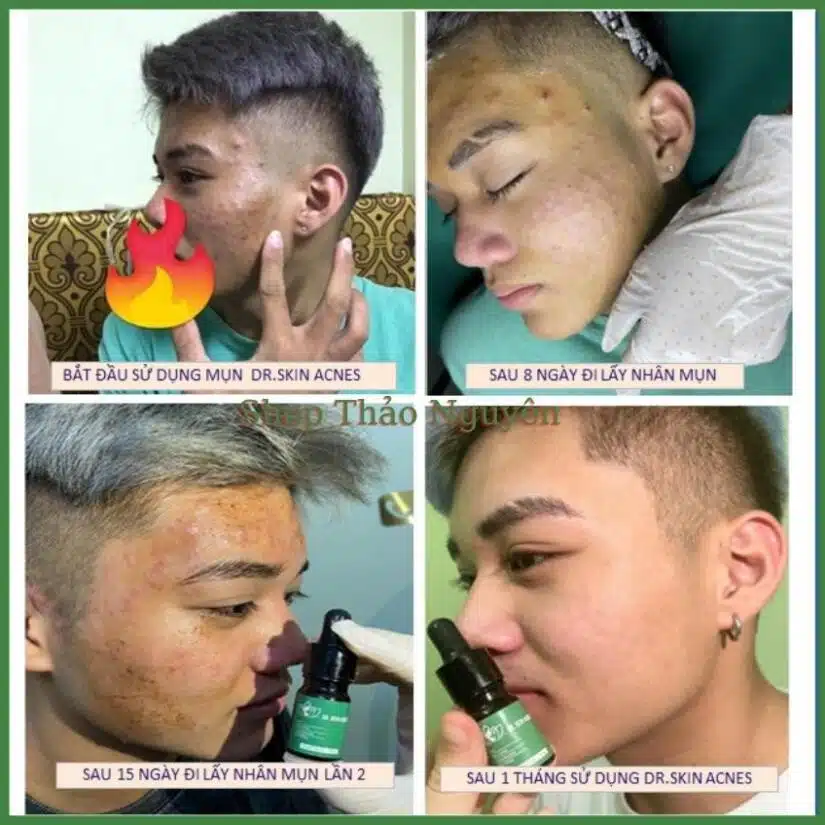 Serum mụn Dr.Skin acnes 5ml đánh bay mụn hết thâm làm mịn da hiệu quả trong 7 ngày 2 images upload woo2F904e860f8d69ec640d272b321feddae5
