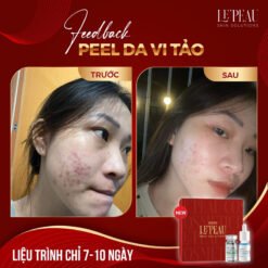 Serum Mụn Diếp Cá LE'PEAU - Giải Pháp Hiệu Quả cho Da Mụn 16 Serum mụn diếp cá LE'PEAU, hỗ trợ cải thiện mụn