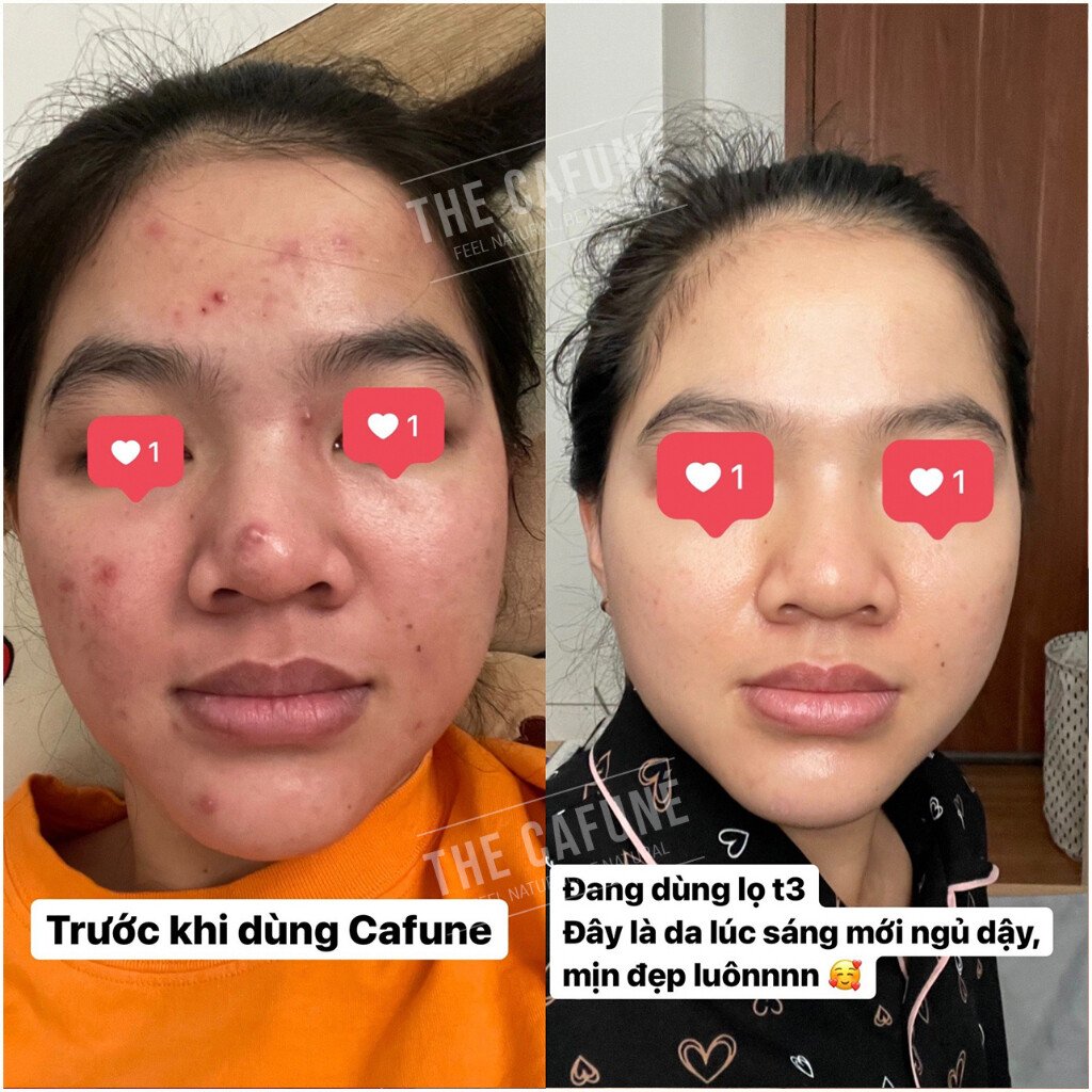 Tinh Chất Chấm Mụn Mờ Thâm Cafuné Essence - Thành Phần Serum AHA Tràm Trà Đánh Bay 7 Loại Mụn Thâm 7 Tinh Chất Chấm Mụn Mờ Thâm, Cafuné Essence, Thành Phần Serum AHA, Tràm Trà, Đánh Bay 7 Loại Mụn Thâm,