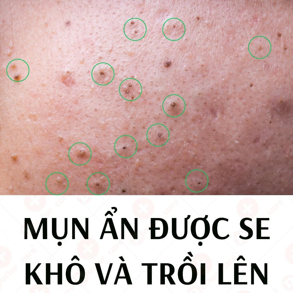 Bộ giảm Mụn ẩn Mụn đầu đen Mụn thâm Doctor Care 20ml (serum+ kem) 5 images upload woo2Fe30525ad04d6342afed596750ec084eb