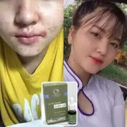 Serum Diếp Cá IGREEN Giải Pháp Hoàn Hảo Cho Da Mụn Thâm 18 Serum Diếp Cá IGREEN Giải Pháp Hoàn Hảo Cho Da Mụn Thâm