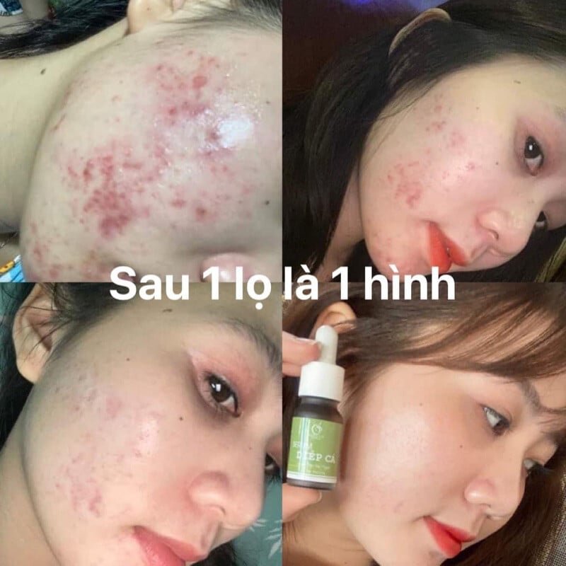 Serum Diếp Cá IGREEN Giải Pháp Hoàn Hảo Cho Da Mụn Thâm 5 Serum Diếp Cá IGREEN Giải Pháp Hoàn Hảo Cho Da Mụn Thâm