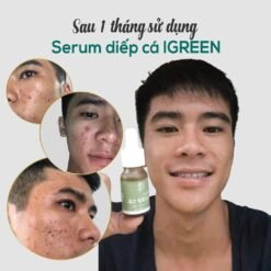 Serum Diếp Cá IGREEN: Giải Pháp Hiệu Quả cho Da Mụn Ẩn và Thâm 10 images upload woo2F1f31e07bf0efa6f3f158fd7220f9e5b0