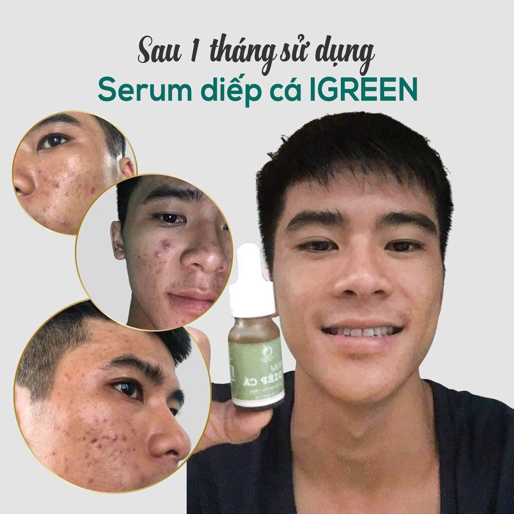 Serum Diếp Cá IGREEN: Giải Pháp Hiệu Quả cho Da Mụn Ẩn và Thâm 3 images upload woo2F1f31e07bf0efa6f3f158fd7220f9e5b0