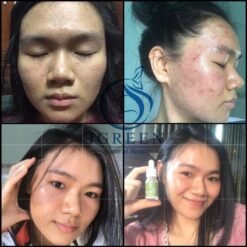 Combo giảm mụn, mờ thâm, dưỡng da sáng mịn IGREEN là sự kết hợp hoàn hảo giữa Serum Diếp Cá IGREEN và Sữa Rửa Mặt Diếp Cá IGREEN 12 Serum Diếp Cá IGREEN Giải Pháp Hoàn Hảo Cho Da Mụn Thâm