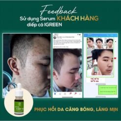 Serum Diếp Cá IGREEN Giải Pháp Hoàn Hảo Cho Da Mụn Thâm 16 Serum Diếp Cá IGREEN Giải Pháp Hoàn Hảo Cho Da Mụn Thâm