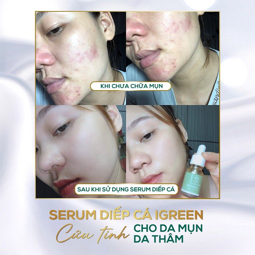 Serum Diếp Cá IGREEN: Giải Pháp Hiệu Quả cho Da Mụn Ẩn và Thâm 4 images upload woo2F721d0904b372373982aafea4e6dc65c8