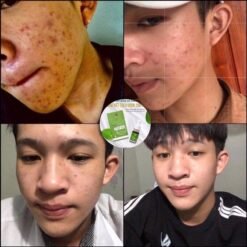 Serum Diếp Cá IGREEN 10ml, Dành Cho Mọi Loại Da, Mụn, Thâm - Tặng Kèm Mặt Nạ 13 images upload woo2F871b4799c1fd09fff936b318dd8dd3ab