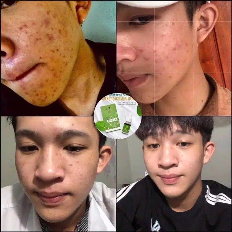 Serum Diếp Cá IGREEN 10ml, Dành Cho Mọi Loại Da, Mụn, Thâm - Tặng Kèm Mặt Nạ 5 images upload woo2F871b4799c1fd09fff936b318dd8dd3ab