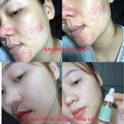 Serum Diếp Cá IGREEN 10ml, Dành Cho Mọi Loại Da, Mụn, Thâm - Tặng Kèm Mặt Nạ 14 images upload woo2F9cf0e5bd8a674f6f49493ff51d0707f0