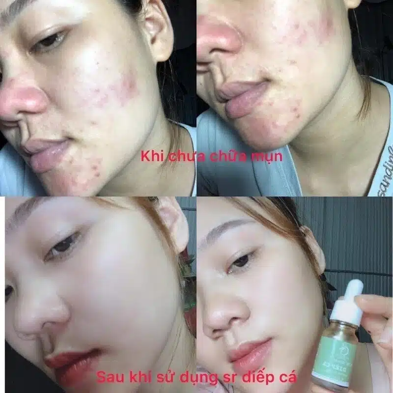 Serum Diếp Cá IGREEN 10ml, Dành Cho Mọi Loại Da, Mụn, Thâm - Tặng Kèm Mặt Nạ 6 images upload woo2F9cf0e5bd8a674f6f49493ff51d0707f0