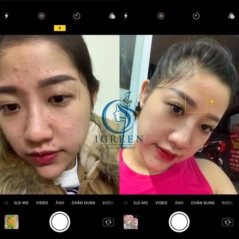 Serum Diếp Cá IGREEN 10ml, Dành Cho Mọi Loại Da, Mụn, Thâm - Tặng Kèm Mặt Nạ 7 images upload woo2Fbece7aadf46ffc75a97abd5ef57ee429