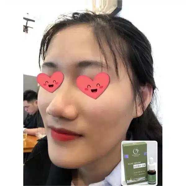 Serum Diếp Cá IGREEN 10ml, Dành Cho Mọi Loại Da, Mụn, Thâm - Tặng Kèm Mặt Nạ 3 images upload woo2Fc0243b9c40aab311a9c8670db3065893