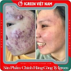 Serum Diếp Cá IGREEN, Giải Pháp Tự Nhiên Cho Da Mụn và Da Nhờn 15 Serum Diếp Cá IGREEN, Giải Pháp Tự Nhiên Cho Da Mụn và Da Nhờn